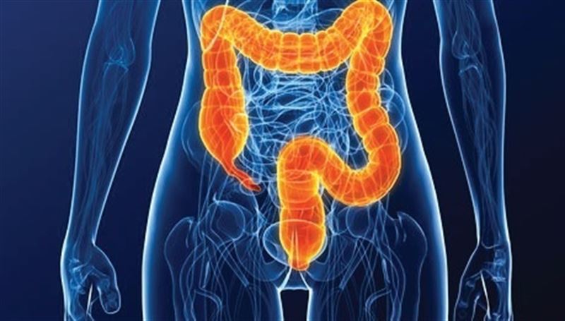 colitis-ulcerosa