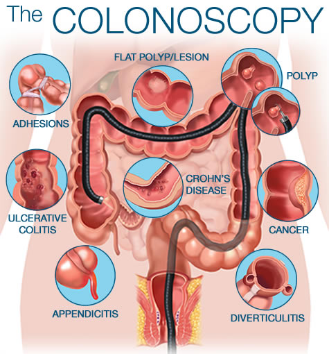 colonoscopia2