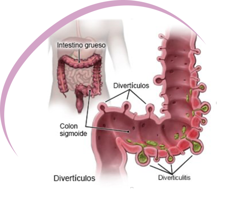 diverticulitis