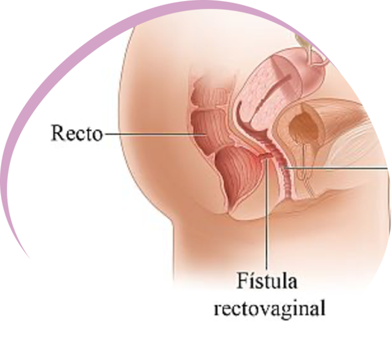 fistulaanovaginal