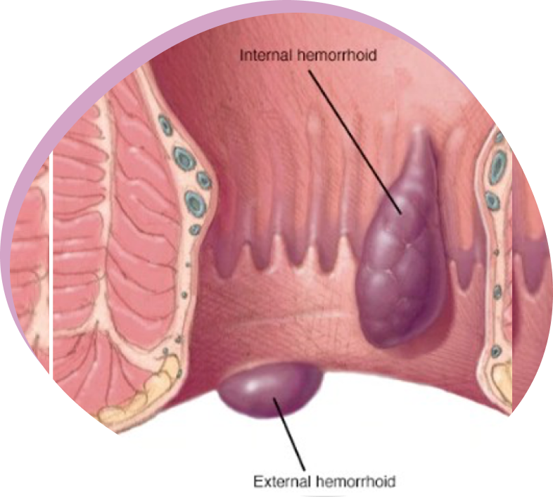 hemorroides